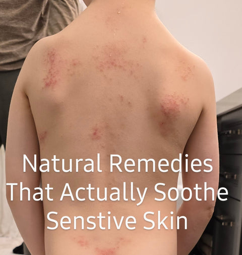 Baby Eczema: Natural Remedies That Actually Soothe Sensitive Skin